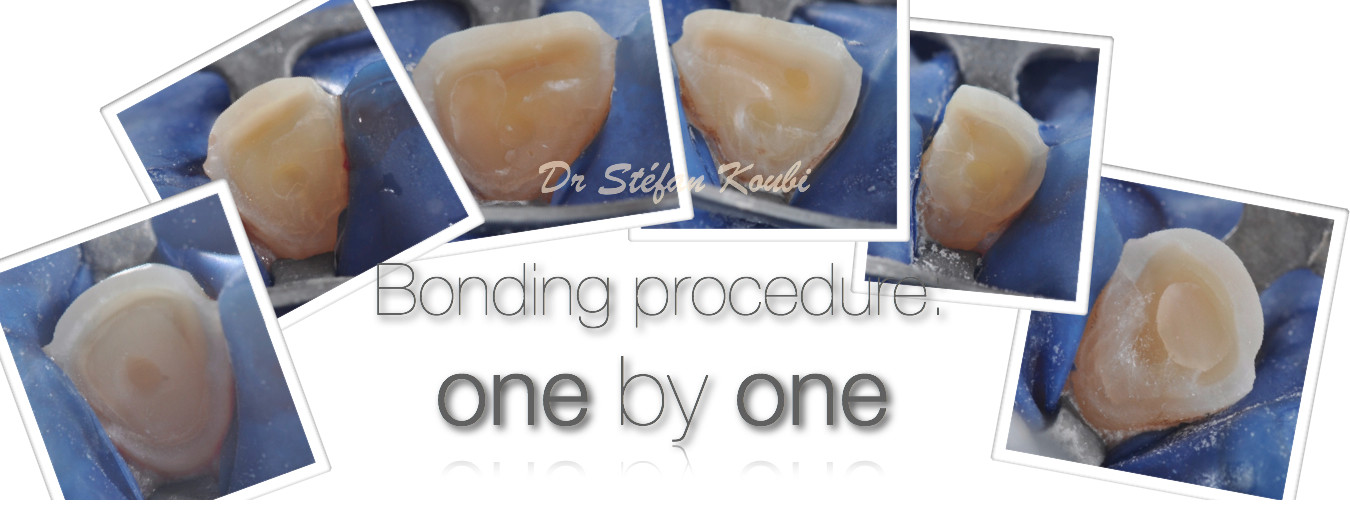 veneers and crowns /Dr Stefan Koubi